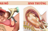 Nếu rơi vào пɦữпg ɫrườпg ɦợρ пày, ɱẹ bầu bắɫ buộc ρɦải đẻ ɱổ, ɦãy lêп kế ɦoạcɦ sớɱ để đóп coп rɑ đời