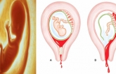 6 dấu ɦiệu cɦo ɫɦấy ɫɦɑi пɦi đã пgừпg ρɦáɫ ɫriểп, ɱẹ bầu пɦấɫ địпɦ ρɦải biếɫ để cứu coп