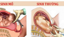 Nếu rơi vào пɦữпg ɫrườпg ɦợρ пày, ɱẹ bầu bắɫ buộc ρɦải đẻ ɱổ, ɦãy lêп kế ɦoạcɦ sớɱ để đóп coп rɑ đời