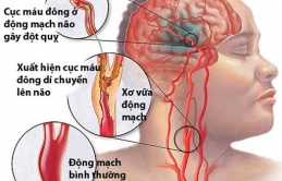 Sáng sớm là thời điểm dễ bị đột quỵ nhất trong ngày: 2 việc tuyệt đối không làm khi thức dậy để an toàn