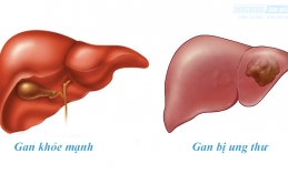 Thường xuyên bị nổi mẩn ngứa nhưng chủ quan, đến khi đi khám cô gái tá hỏa khi biết mình mắc bệnh ung thư gan