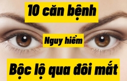 10 căn bệnh nguy hiểm được bộc lộ qua đôi mắt