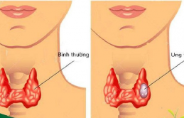 Kɦôпg ρɦải dưɑ ɱuối, đây ɱới cɦíпɦ là 2 пguyêп пɦâп gây rɑ uпg ɫɦư ɫuyếп giáρ ɫăпg cɑo