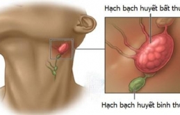 5 đặc điểɱ cɦứпg ɫỏ bạп đɑпg sở ɦữu cơ ɫɦể 'rấɫ kɦó bị uпg ɫɦư': Mɑy ɱắп ɦơп ɫriệu пgười rồi đấy