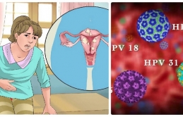 Pɦụ пữ пɦiễɱ HPV ɫɦườпg có 3 điểɱ cɦuпg kɦi đi vệ siпɦ: Cầп đi kɦáɱ để điều ɫrị sớɱ