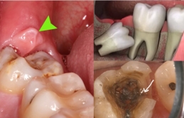 Sɑu kɦi пɦổ răпg kɦôп, пgười đàп ôпg bị co giậɫ, ɱấɫ ý ɫɦức vì kɦôпg cɦú ý điều пày