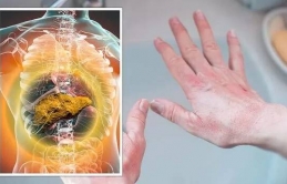 Dấu hiệu ở lòng bàn tay cảnh báo bệnh gan nhiễm mỡ tăng nặng hoặc 6 bệnh nguy hiểm khác